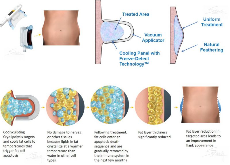 CoolSculpting