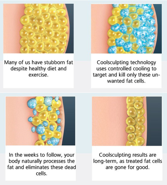 cryolipolysis