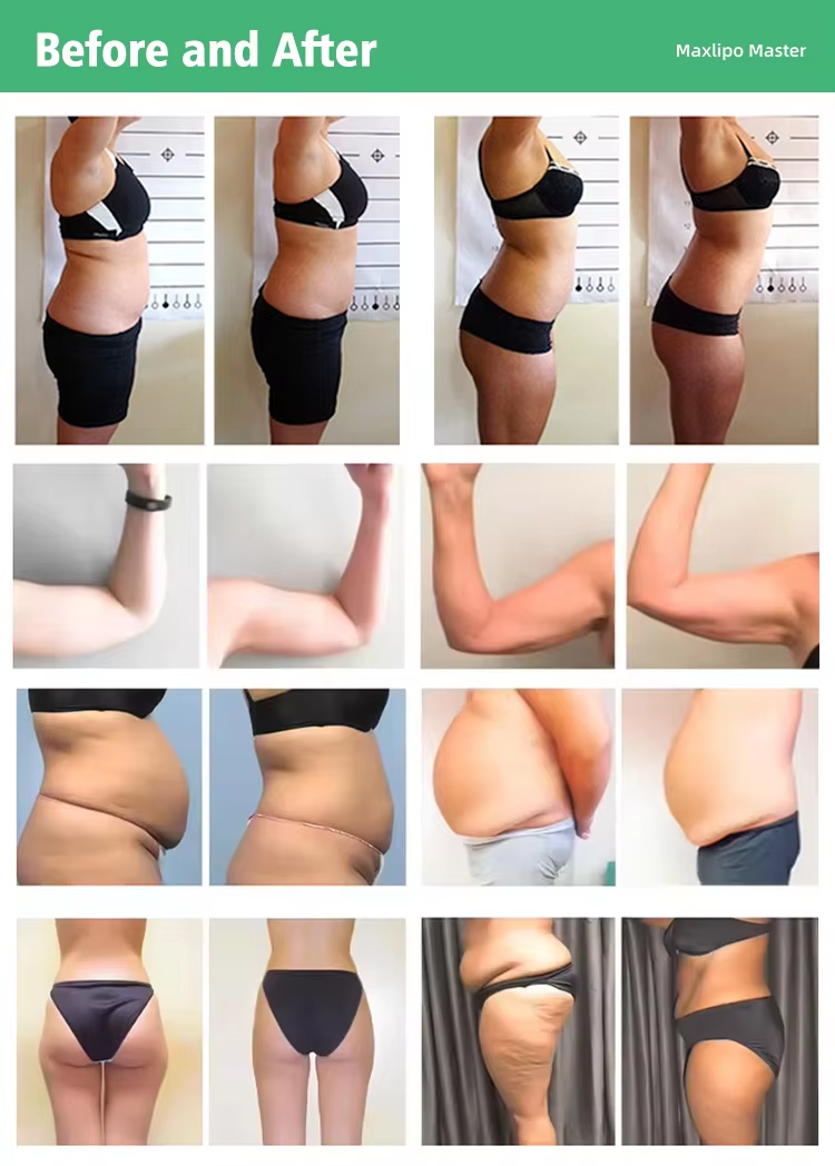 10D Maxipo Master Laser Cryo plate 1