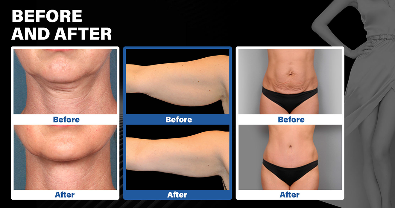Non-Surgical Body Contouring Equipment