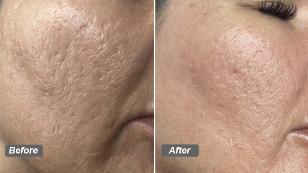 co2 fractional laser treatment for acne scars