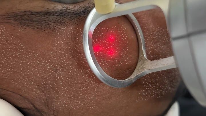 fractional laser safely