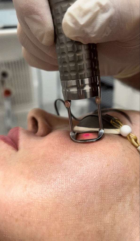 fractional laser operation