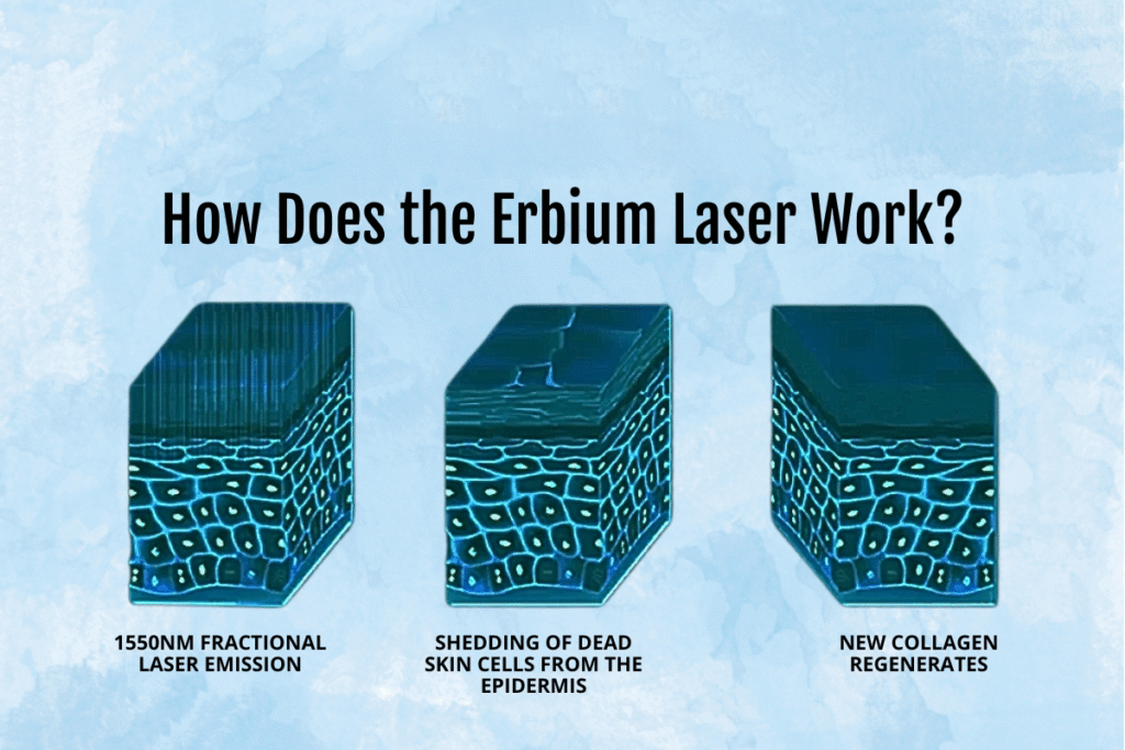 1550nm erbium glass laser