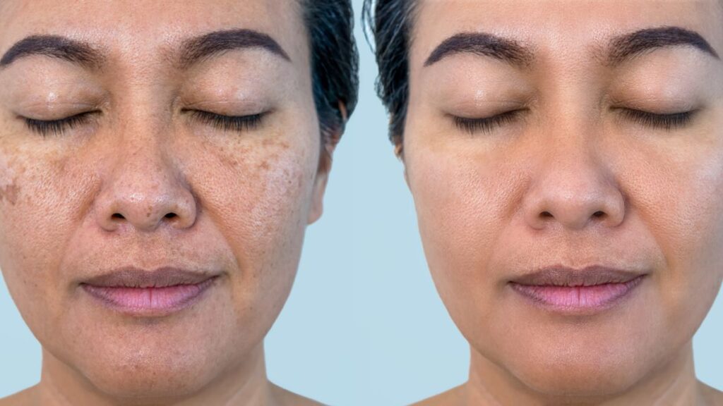 hyperpigmentation treatment options