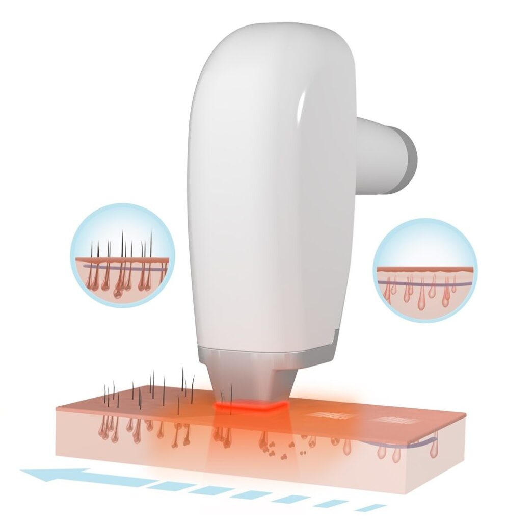 808nm diode laser hair removal