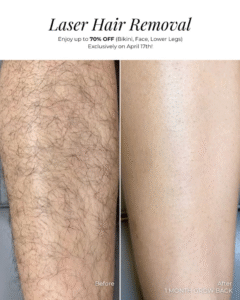 laser hair removal treatment before and after