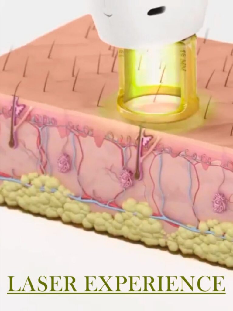 best laser for hair removal