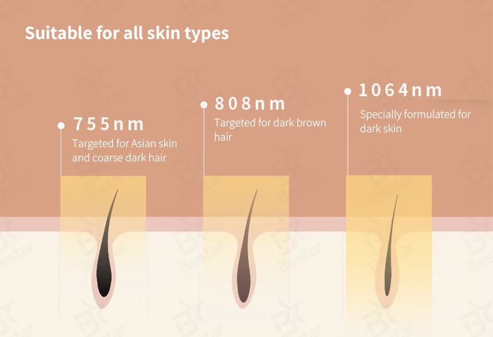 diode laser hair removal machine